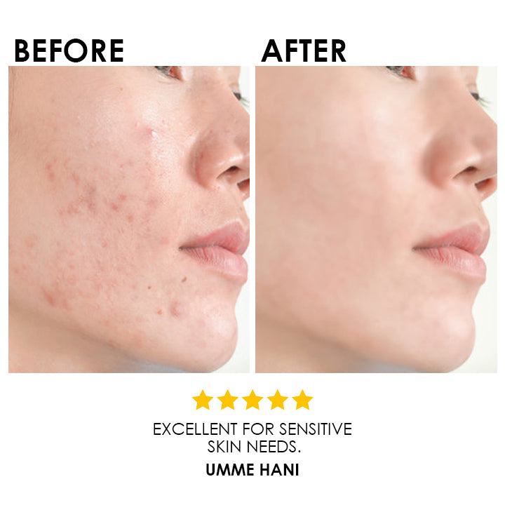 TEA TREE SERUM