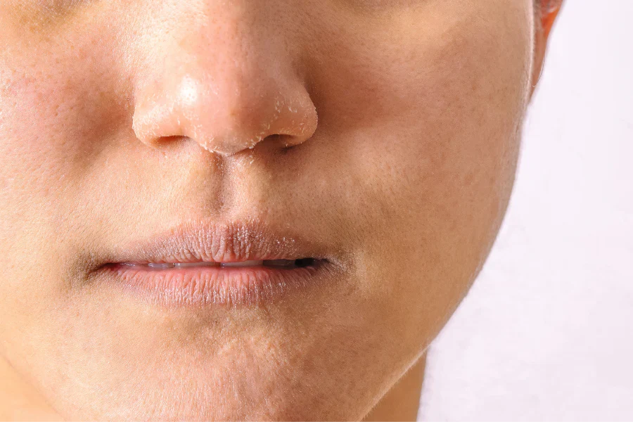 Dry & Dehydrated Skin