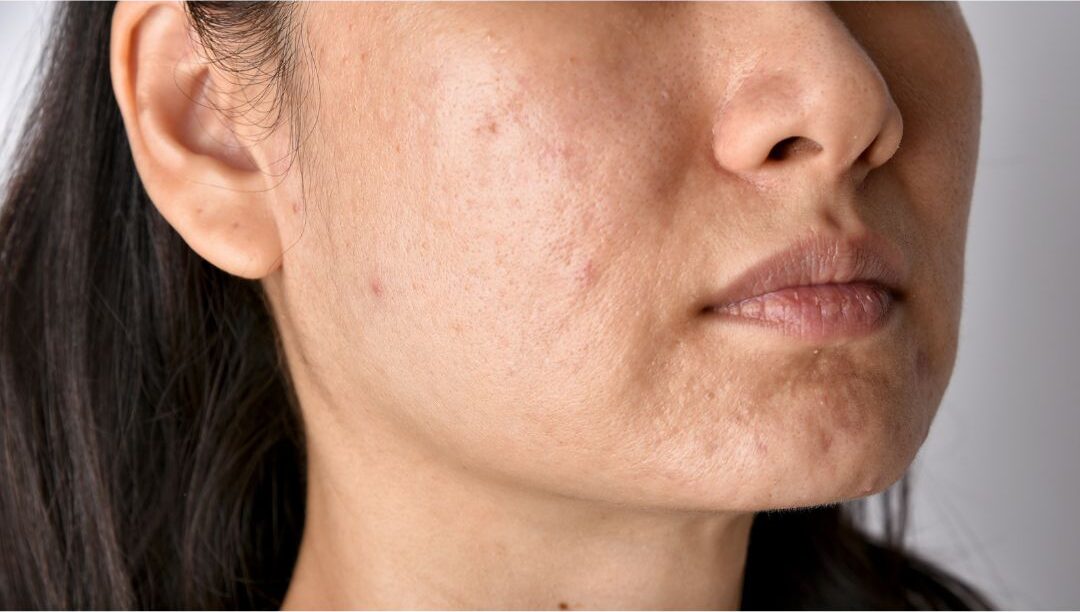 Uneven Skin Tone & Dullness