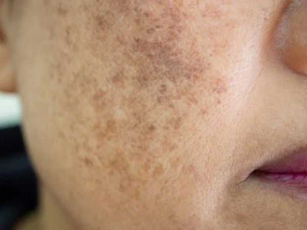 Hyperpigmentation & Melasma
