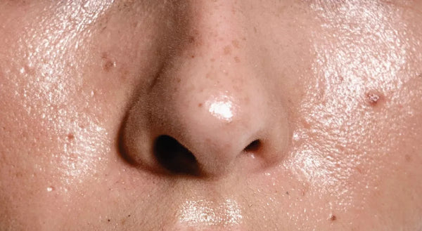 Oily & Congested Skin