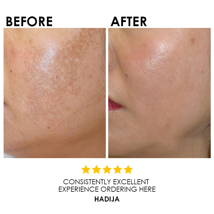 Blysmo Melasma Serum 30 Ml in Pakistan